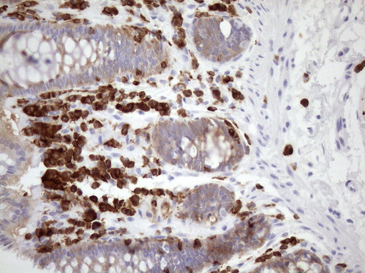 URP2 / FERMT3 Antibody - Immunohistochemical staining of paraffin-embedded Human colon tissue within the normal limits using anti-FERMT3 mouse monoclonal antibody. (Heat-induced epitope retrieval by 1mM EDTA in 10mM Tris buffer. (pH8.5) at 120 oC for 3 min. (1:150)