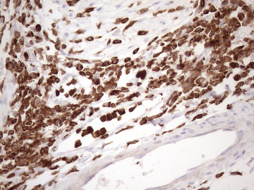 URP2 / FERMT3 Antibody - Immunohistochemical staining of paraffin-embedded Adenocarcinoma of Human colon tissue using anti-FERMT3 mouse monoclonal antibody. (Heat-induced epitope retrieval by 1mM EDTA in 10mM Tris buffer. (pH8.5) at 120 oC for 3 min. (1:150)