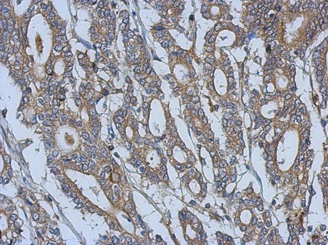 URP2 / FERMT3 Antibody - IHC of paraffin-embedded Gastric ca, using URP2 antibody at 1:500 dilution.