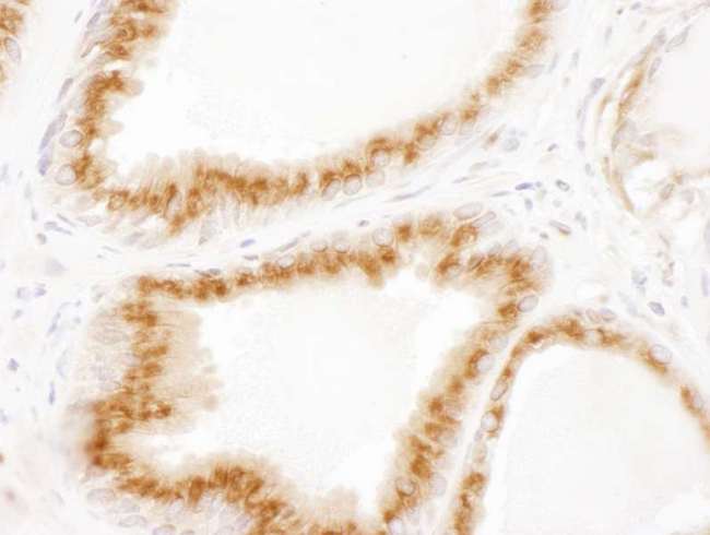 US01 / p115 Antibody - Detection of human p115 by immunohistochemistry. Sample: FFPE section of human prostate carcinoma. Antibody: Affinity purified rabbit anti- p115 used at a dilution of 1:1,000 (1µg/ml). Detection: DAB