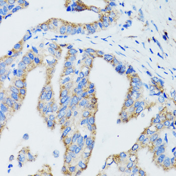 US01 / p115 Antibody - Immunohistochemistry of paraffin-embedded human gastric cancer tissue.