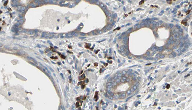 US01 / p115 Antibody - 1:100 staining human prostate tissue by IHC-P. The sample was formaldehyde fixed and a heat mediated antigen retrieval step in citrate buffer was performed. The sample was then blocked and incubated with the antibody for 1.5 hours at 22°C. An HRP conjugated goat anti-rabbit antibody was used as the secondary.