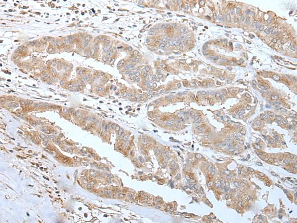 US01 / p115 Antibody - Immunohistochemistry of paraffin-embedded Human liver cancer tissue  using USO1 Polyclonal Antibody at dilution of 1:30(×200)