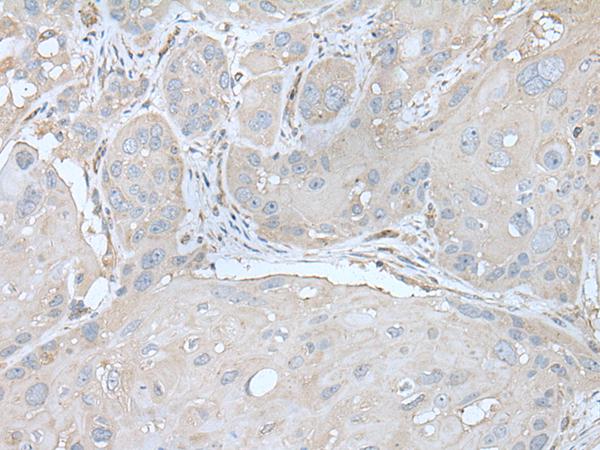 US01 / p115 Antibody - Immunohistochemistry of paraffin-embedded Human esophagus cancer tissue  using USO1 Polyclonal Antibody at dilution of 1:30(×200)