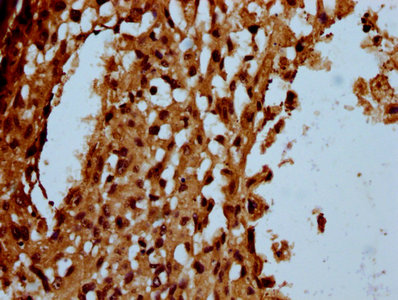 USB1 Antibody - Immunohistochemistry Dilution at 1:100 and staining in paraffin-embedded human melanoma cancer performed on a Leica BondTM system. After dewaxing and hydration, antigen retrieval was mediated by high pressure in a citrate buffer (pH 6.0). Section was blocked with 10% normal Goat serum 30min at RT. Then primary antibody (1% BSA) was incubated at 4°C overnight. The primary is detected by a biotinylated Secondary antibody and visualized using an HRP conjugated SP system.