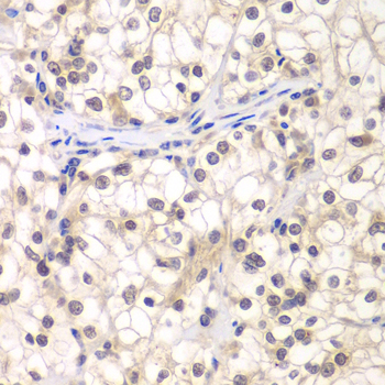 USF1 / USF Antibody - Immunohistochemistry of paraffin-embedded human kidney cancer tissue.
