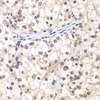 USF1 / USF Antibody - Immunohistochemistry of paraffin-embedded human kidney cancer using USF1 antibody at dilution of 1:200 (40x lens).