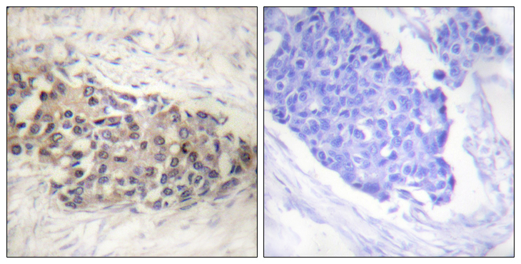 USF2 Antibody - Immunohistochemistry analysis of paraffin-embedded human breast carcinoma tissue, using USF2 Antibody. The picture on the right is blocked with the synthesized peptide.