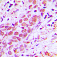 USF2 Antibody - Immunohistochemical analysis of USF2 staining in human breast cancer formalin fixed paraffin embedded tissue section. The section was pre-treated using heat mediated antigen retrieval with sodium citrate buffer (pH 6.0). The section was then incubated with the antibody at room temperature and detected using an HRP conjugated compact polymer system. DAB was used as the chromogen. The section was then counterstained with hematoxylin and mounted with DPX.