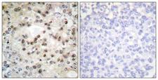 USF2 Antibody - Peptide - + Immunohistochemistry analysis of paraffin-embedded human breast carcinoma tissue using USF2 antibody.