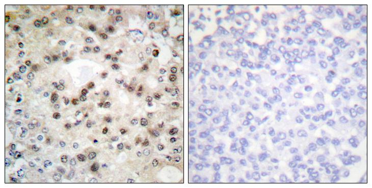USF2 Antibody - Peptide - + Immunohistochemistry analysis of paraffin-embedded human breast carcinoma tissue using USF2 antibody.