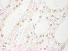 USP1 Antibody - Detection of Human USP1 by Immunohistochemistry. Sample: FFPE section of human thyroid carcinoma. Antibody: Affinity purified rabbit anti-USP1 used at a dilution of 1:250.