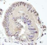 USP10 Antibody - Detection of Human USP10 by Immunohistochemistry. Sample: FFPE section of human lung adenocarcinoma. Antibody: Affinity purified rabbit anti-USP10 used at a dilution of 1:100.