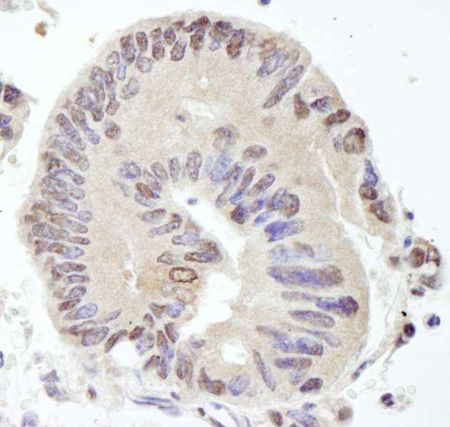 USP10 Antibody - Detection of Human USP10 by Immunohistochemistry. Sample: FFPE section of human lung adenocarcinoma. Antibody: Affinity purified rabbit anti-USP10 used at a dilution of 1:100.