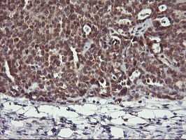 USP10 Antibody - IHC of paraffin-embedded Adenocarcinoma of Human ovary tissue using anti-USP10 mouse monoclonal antibody.