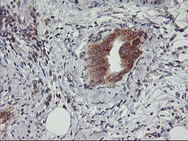 USP10 Antibody - IHC of paraffin-embedded Carcinoma of Human pancreas tissue using anti-USP10 mouse monoclonal antibody.