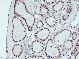 USP10 Antibody - IHC of paraffin-embedded Carcinoma of Human thyroid tissue using anti-USP10 mouse monoclonal antibody.