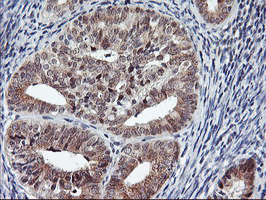 USP10 Antibody - IHC of paraffin-embedded Adenocarcinoma of Human endometrium tissue using anti-USP10 mouse monoclonal antibody.