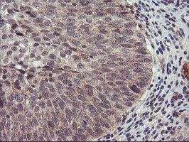 USP10 Antibody - IHC of paraffin-embedded Carcinoma of Human bladder tissue using anti-USP10 mouse monoclonal antibody.