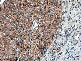 USP10 Antibody - IHC of paraffin-embedded Carcinoma of Human bladder tissue using anti-USP10 mouse monoclonal antibody.