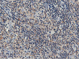 USP10 Antibody - IHC of paraffin-embedded Human lymphoma tissue using anti-USP10 mouse monoclonal antibody.