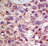 USP11 Antibody - Formalin-fixed and paraffin-embedded human cancer tissue reacted with the primary antibody, which was peroxidase-conjugated to the secondary antibody, followed by AEC staining. This data demonstrates the use of this antibody for immunohistochemistry; clinical relevance has not been evaluated. BC = breast carcinoma; HC = hepatocarcinoma.
