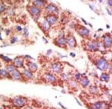 USP12 Antibody - Formalin-fixed and paraffin-embedded human cancer tissue reacted with the primary antibody, which was peroxidase-conjugated to the secondary antibody, followed by AEC staining. This data demonstrates the use of this antibody for immunohistochemistry; clinical relevance has not been evaluated. BC = breast carcinoma; HC = hepatocarcinoma.