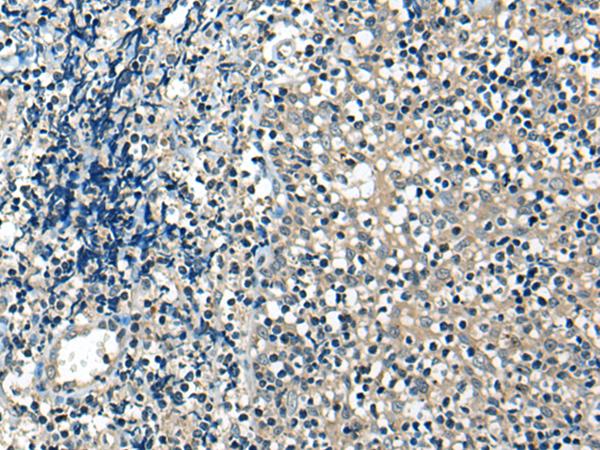 USP12 Antibody - Immunohistochemistry of paraffin-embedded Human tonsil tissue  using USP12 Polyclonal Antibody at dilution of 1:35(×200)
