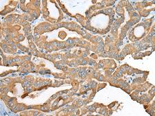 USP12 Antibody - Immunohistochemistry of paraffin-embedded Human thyroid cancer tissue  using USP12 Polyclonal Antibody at dilution of 1:35(×200)