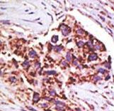 USP13 Antibody - Formalin-fixed and paraffin-embedded human cancer tissue reacted with the primary antibody, which was peroxidase-conjugated to the secondary antibody, followed by DAB staining. This data demonstrates the use of this antibody for immunohistochemistry; clinical relevance has not been evaluated. BC = breast carcinoma; HC = hepatocarcinoma.