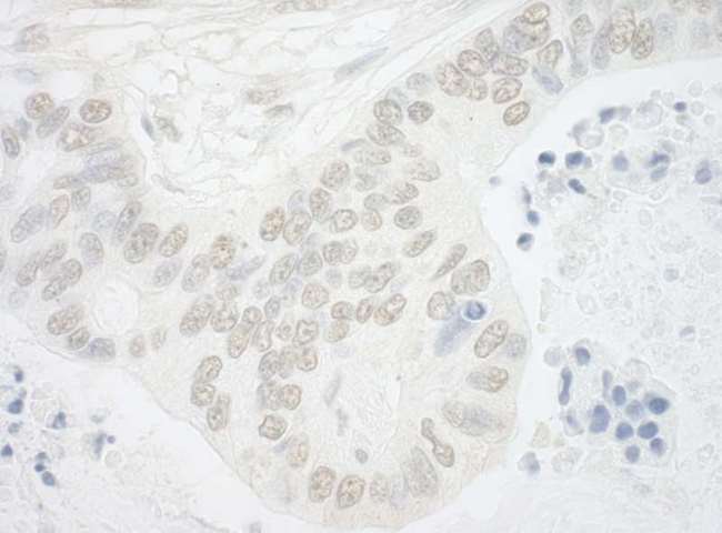 USP13 Antibody - Detection of Human USP13 by Immunohistochemistry. Sample: FFPE section of human ovarian carcinoma. Antibody: Affinity purified rabbit anti-USP13 used at a dilution of 1:5000 (0.2 Detection: DAB.