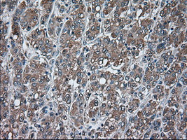 USP13 Antibody - Immunohistochemical staining of paraffin-embedded Carcinoma of liver tissue using anti-USP13 mouse monoclonal antibody. (Dilution 1:50).