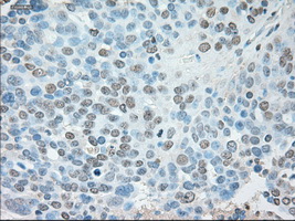 USP13 Antibody - Immunohistochemical staining of paraffin-embedded Adenocarcinoma of ovary tissue using anti-USP13 mouse monoclonal antibody. (Dilution 1:50).