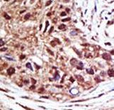 USP14 Antibody - Formalin-fixed and paraffin-embedded human cancer tissue reacted with the primary antibody, which was peroxidase-conjugated to the secondary antibody, followed by AEC staining. This data demonstrates the use of this antibody for immunohistochemistry; clinical relevance has not been evaluated. BC = breast carcinoma; HC = hepatocarcinoma.