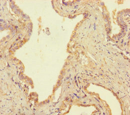 USP14 Antibody - Immunohistochemistry of paraffin-embedded human prostate cancer using USP14 Antibody at dilution of 1:100