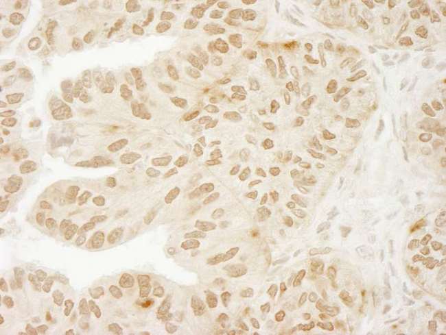 USP15 Antibody - Detection of Human USP15 by Immunohistochemistry. Sample: FFPE section of human ovarian carcinoma. Antibody: Affinity purified rabbit anti-USP15 used at a dilution of 1:100. Epitope Retrieval Buffer-High pH (IHC-101J) was substituted for Epitope Retrieval Buffer-Reduced pH.