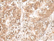 USP16 Antibody - Immunohistochemistry of paraffin-embedded Human gastric cancer tissue  using USP16 Polyclonal Antibody at dilution of 1:25(×200)