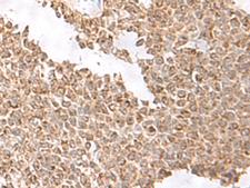 USP16 Antibody - Immunohistochemistry of paraffin-embedded Human ovarian cancer tissue  using USP16 Polyclonal Antibody at dilution of 1:75(×200)