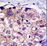 USP2 Antibody - Formalin-fixed and paraffin-embedded human cancer tissue reacted with the primary antibody, which was peroxidase-conjugated to the secondary antibody, followed by DAB staining. This data demonstrates the use of this antibody for immunohistochemistry; clinical relevance has not been evaluated. BC = breast carcinoma; HC = hepatocarcinoma.