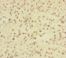USP2 Antibody - Immunohistochemistry of paraffin-embedded human glioma cancer at dilution of 1:100