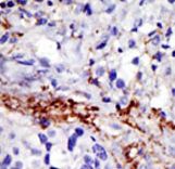 USP21 Antibody - Formalin-fixed and paraffin-embedded human cancer tissue reacted with the primary antibody, which was peroxidase-conjugated to the secondary antibody, followed by DAB staining. This data demonstrates the use of this antibody for immunohistochemistry; clinical relevance has not been evaluated. BC = breast carcinoma; HC = hepatocarcinoma.