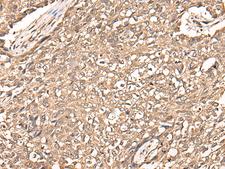 USP21 Antibody - Immunohistochemistry of paraffin-embedded Human lung cancer tissue  using USP21 Polyclonal Antibody at dilution of 1:50(×200)