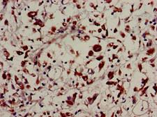 USP22 Antibody - Immunohistochemistry image of paraffin-embedded human melanoma cancer at a dilution of 1:100