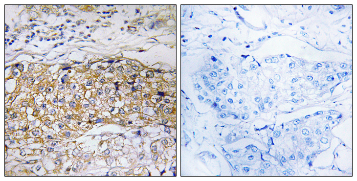 USP24 Antibody - Immunohistochemistry analysis of paraffin-embedded human breast carcinoma tissue, using USP24 Antibody. The picture on the right is blocked with the synthesized peptide.