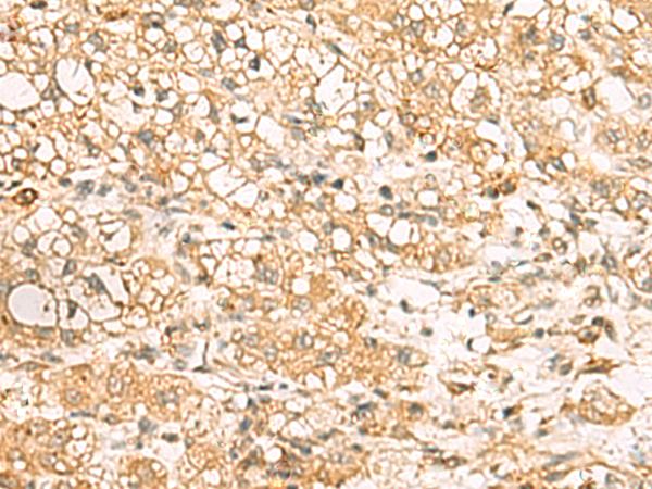 USP24 Antibody - Immunohistochemistry of paraffin-embedded Human liver cancer tissue  using USP24 Polyclonal Antibody at dilution of 1:35(×200)