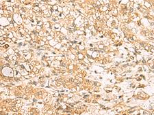 USP24 Antibody - Immunohistochemistry of paraffin-embedded Human liver cancer tissue  using USP24 Polyclonal Antibody at dilution of 1:35(×200)
