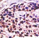 USP25 Antibody - Formalin-fixed and paraffin-embedded human cancer tissue reacted with the primary antibody, which was peroxidase-conjugated to the secondary antibody, followed by DAB staining. This data demonstrates the use of this antibody for immunohistochemistry; clinical relevance has not been evaluated. BC = breast carcinoma; HC = hepatocarcinoma.