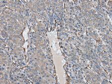 USP25 Antibody - Immunohistochemistry of paraffin-embedded Human liver cancer tissue  using USP25 Polyclonal Antibody at dilution of 1:40(×200)