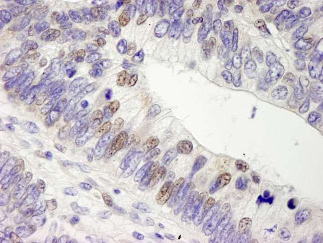 USP28 Antibody - Detection of Human USP28 by Immunohistochemistry. Sample: FFPE section of human colon adenocarcinoma. Antibody: Affinity purified rabbit anti-USP28 used at a dilution of 1:250.