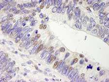 USP28 Antibody - Detection of Human USP28 by Immunohistochemistry. Sample: FFPE section of human colon adenocarcinoma. Antibody: Affinity purified rabbit anti-USP28 used at a dilution of 1:250.